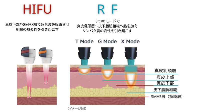 美容機器のHIFUとRFの比較図。HIFUは真皮下部やSMAS層に音波を照射し、組織の熱変性を引き起こす。RFは3つのモード(Tモード、Gモード、Xモード)で真皮乳頭層から皮下脂肪層に熱を加え、タンパク質の変性を促進する様子を示している。